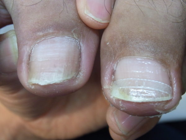 登米の巻き爪専門院が伝えたい 爪の切りすぎによる陥入爪 痛み 出血 登米市で巻き爪にお悩みなら 登米巻き爪矯正院