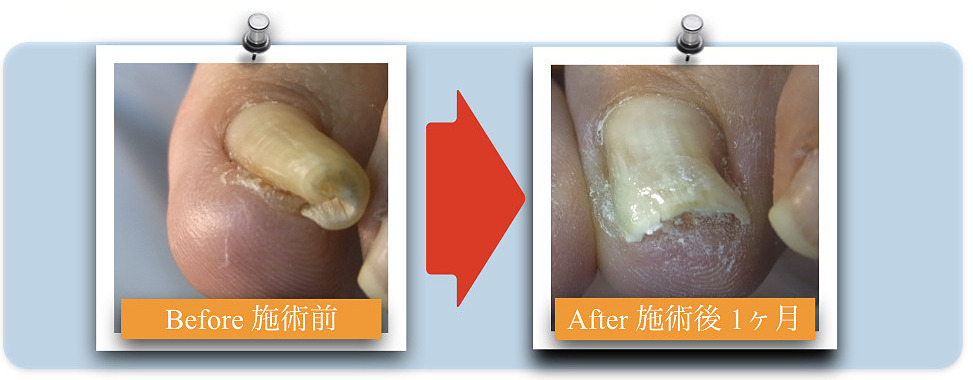 登米巻き爪の矯正施術