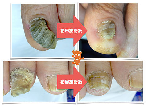 登米院の変形爪修復施術